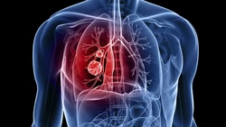 Le Tabagisme Est La Principale Cause De Cancer Du Poumon