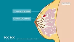 Recherche Sur La Prvention Et Les Causes Du Cancer Du Sein